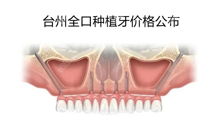 台州全口种植牙价格公布