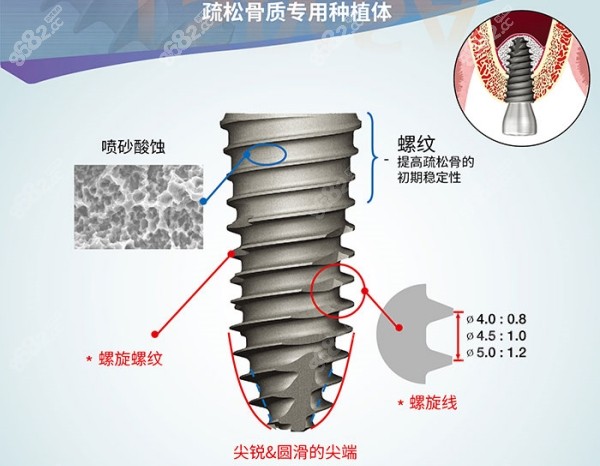 广州奥齿泰种植牙多少钱一颗8682.cc