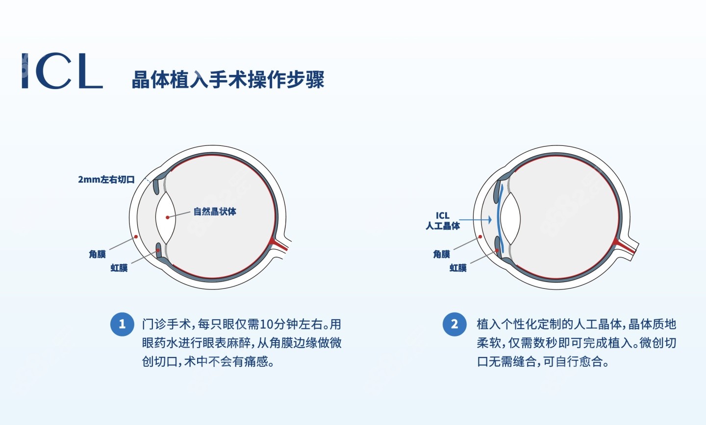 南宁做icl晶体植入的价格和医院有关