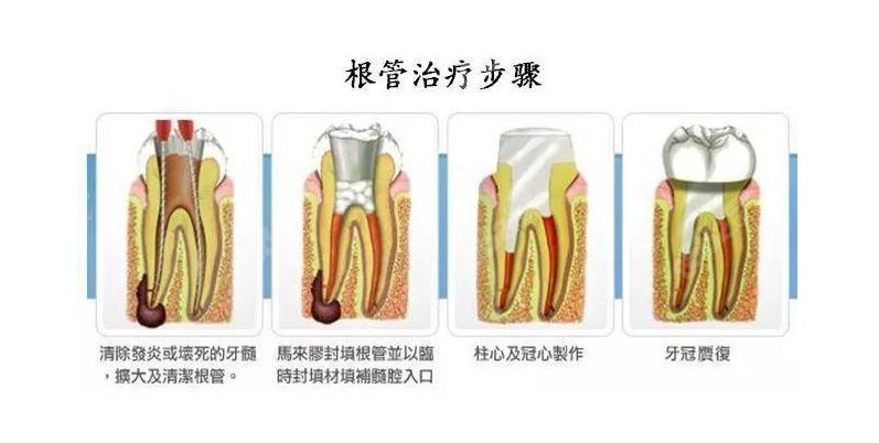 根管治疗后做牙套