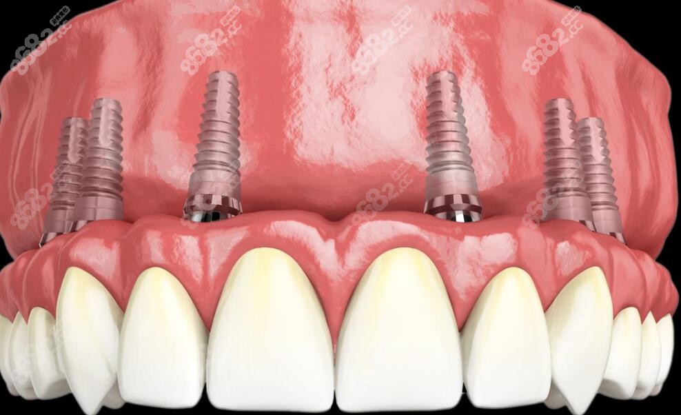 全口种植牙卡通图www.8682.cc