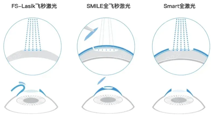 广州治近视眼好的医院可做激光近视矫正手术8682.cc