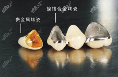 牙冠照片