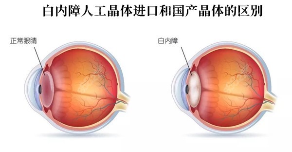 白内障人工晶体进口和国产晶体的区别有哪些