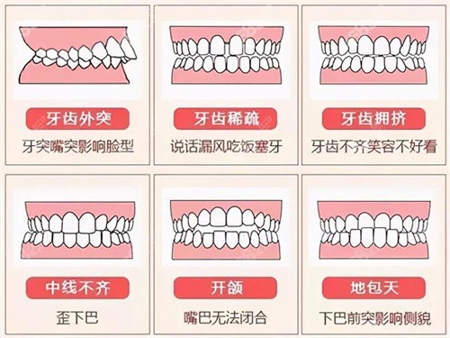 东莞天使口腔正畸价格表全新上线，自锁矫正降至低1.5w起