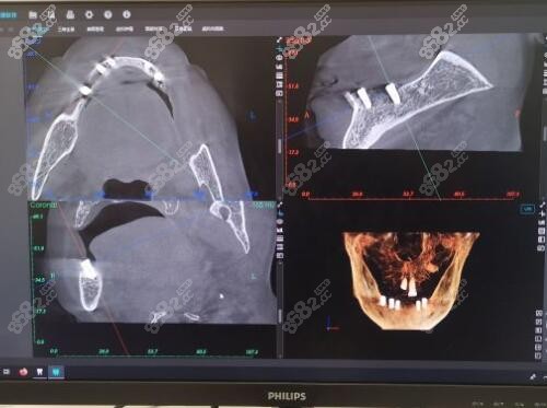 富阳金铂利口腔种植牙技术怎么样 富阳金铂利口腔种植牙技术怎么样