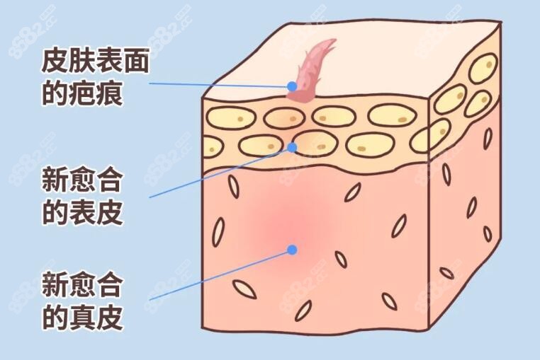 皮肤疤痕修复的表现