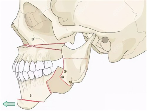 正颌及轮廓下巴手术示意图
