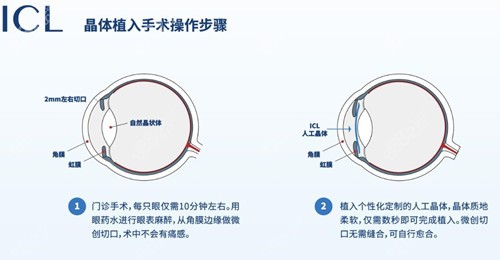 近视眼晶体植入手术比激光手术贵的原因