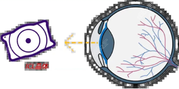 进口晶体植入和国产晶体植入清晰度不一样