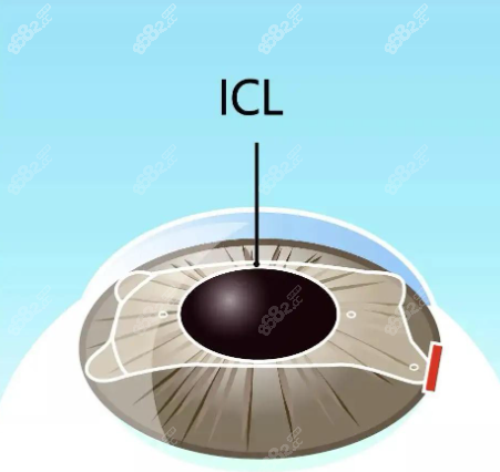 眼睛晶体植入图www.8682.cc