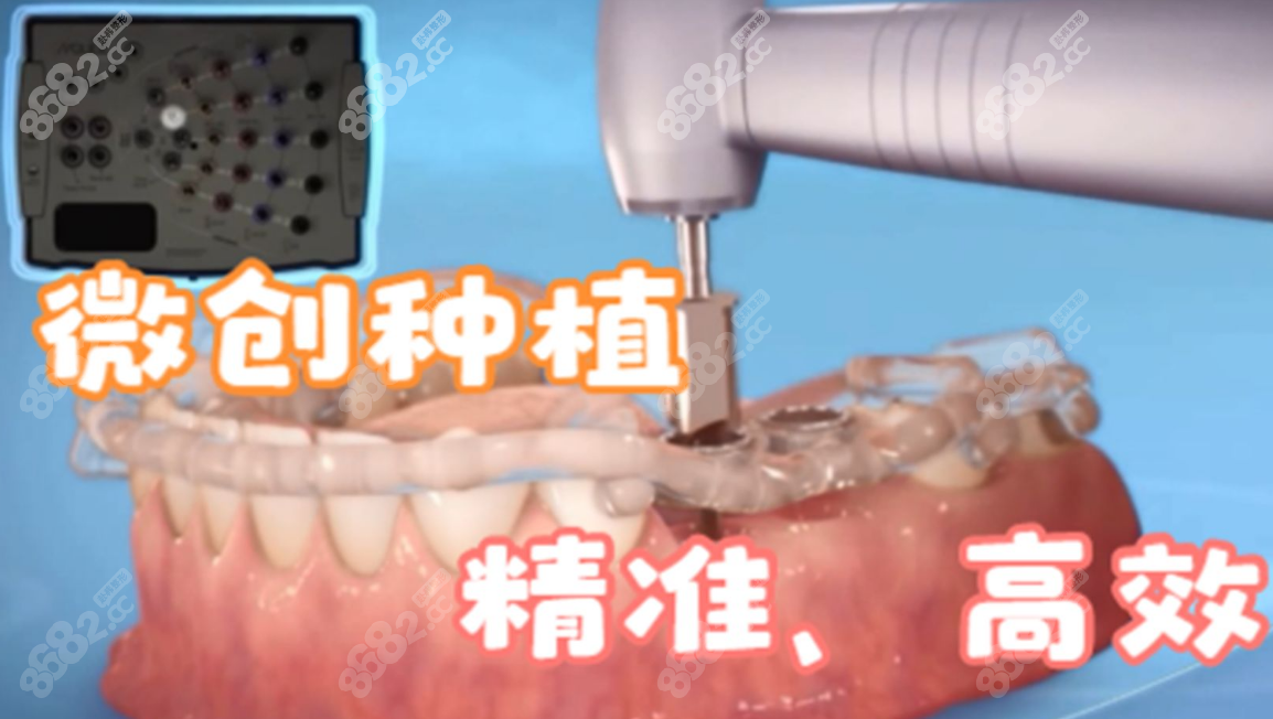 <!--<i data=20240705-sp></i>-->医院中韩口腔种植牙m.8682.cc