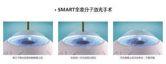 SMART全准分子激光近视手术多久恢复