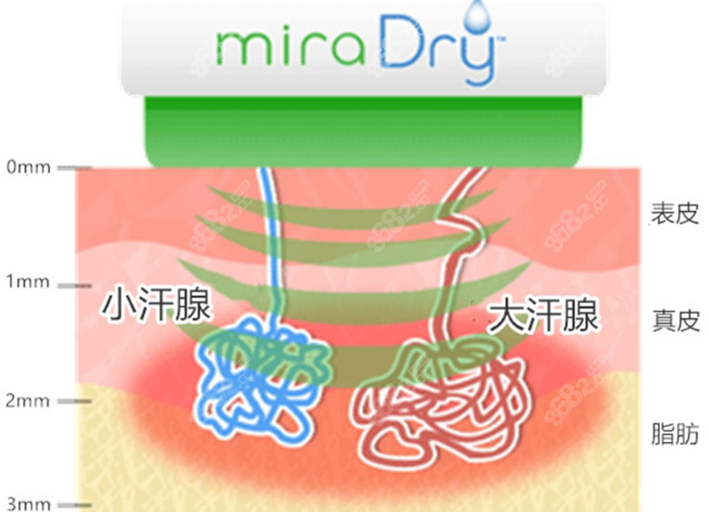 杭州miradry清新微波去腋臭优势