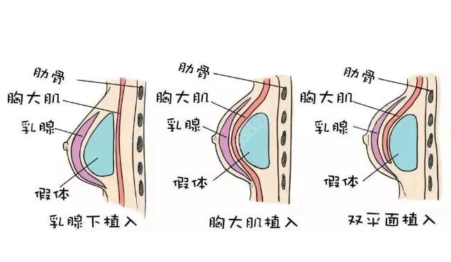 上海假体隆胸实惠的医院有哪些