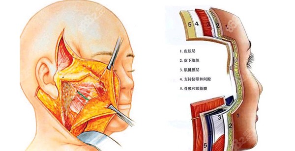 杨大平医生处理高难度拉皮病例时的一些技巧