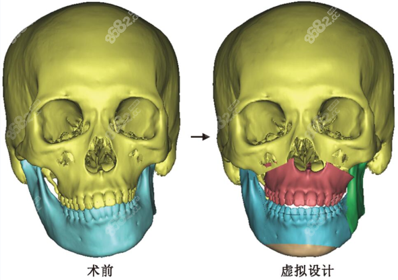 数字化正颌手术设计