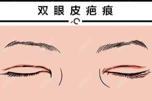 双眼皮修复示意图
