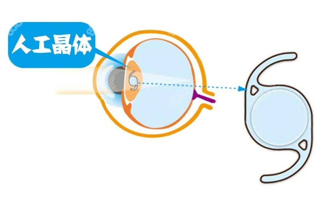 白内障人工晶体进口和国产晶体的区别