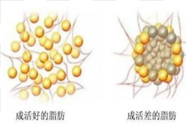 异常成活脂肪块儿影响美观