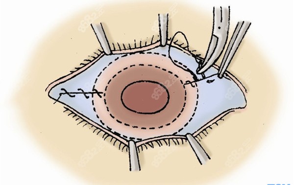 巩膜移植手术需要30000元起