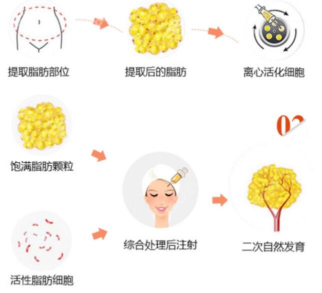 脂肪移植的手術操作流程示意圖