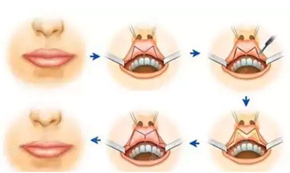 厚唇改薄手术过程