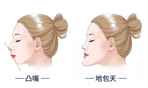 凸嘴和地包天的表现