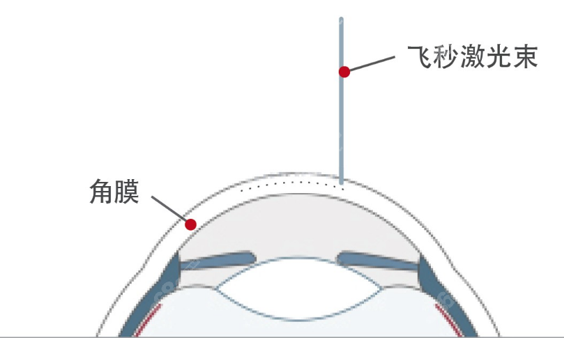 半飞秒激光近视手术