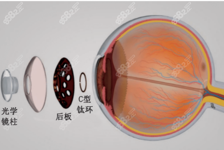 人工角膜移植