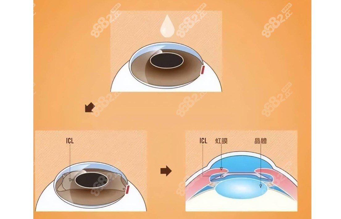 高度近视能做晶体植入