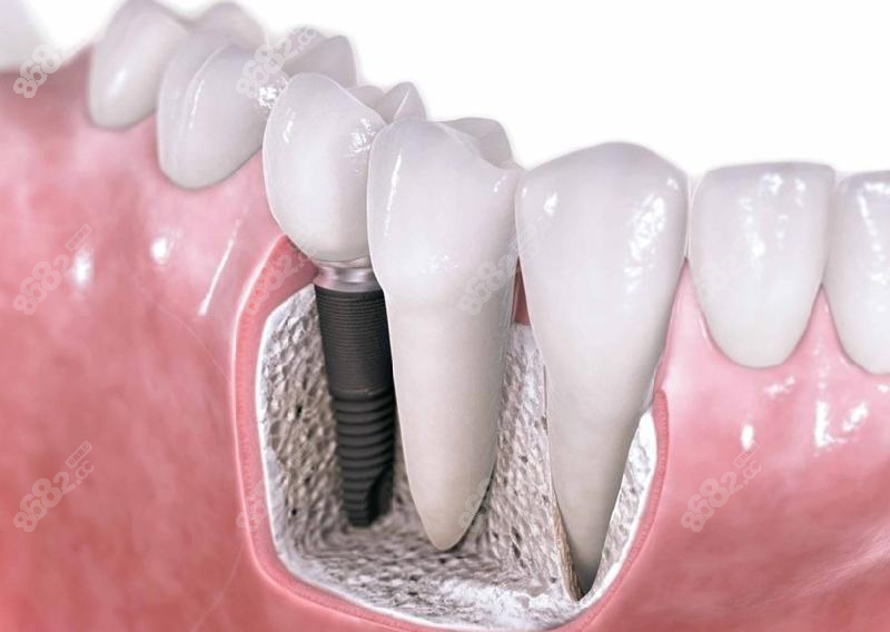 登特口腔2023种植牙收费价目表 登特口腔2023种植牙收费价目表