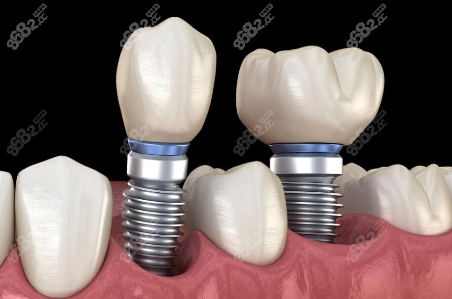 湘潭品之冠口腔种植牙多少钱一颗