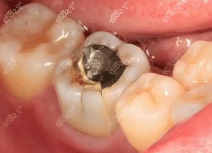 牙齿龋坏照片