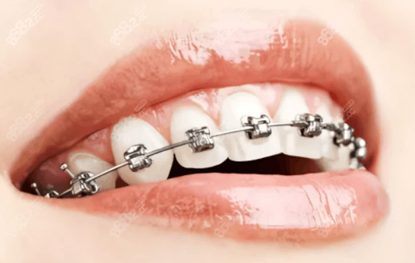 牙齿矫正 牙齿矫正