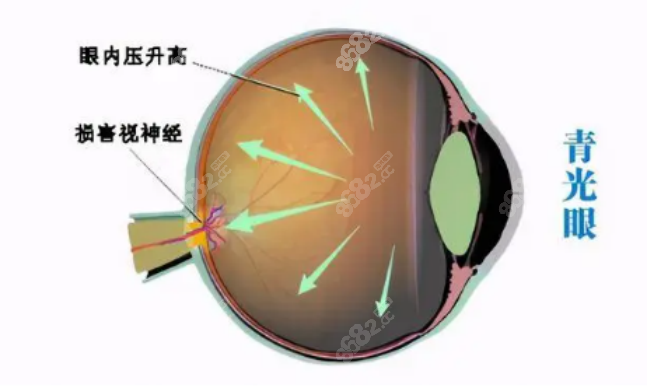 青光眼治疗