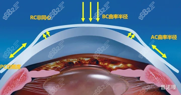 普诺瞳角膜塑形镜优点和设计分析