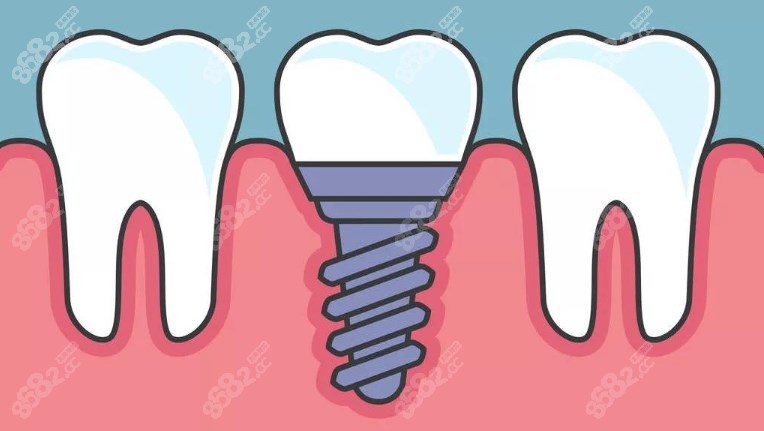 乌鲁木齐臻美口腔种植牙