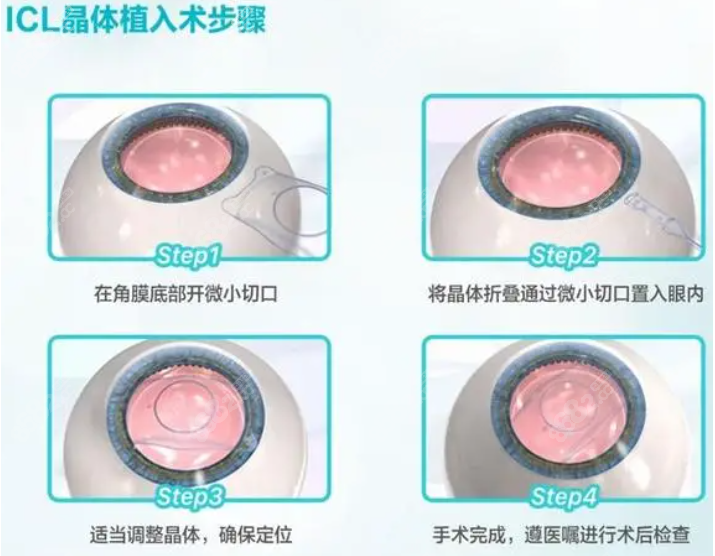 icl晶体植入近视手术过程图解