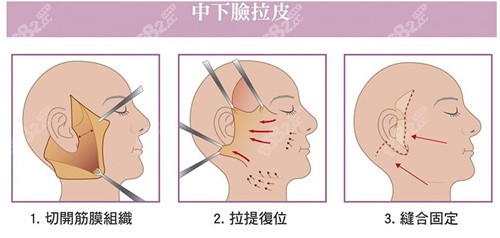 贵阳丽都整形医院院长陈诚做拉皮好