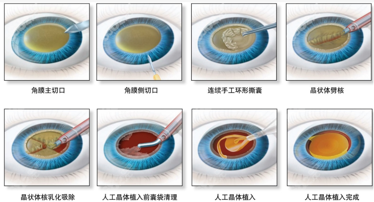 白内障晶体植入手术过程