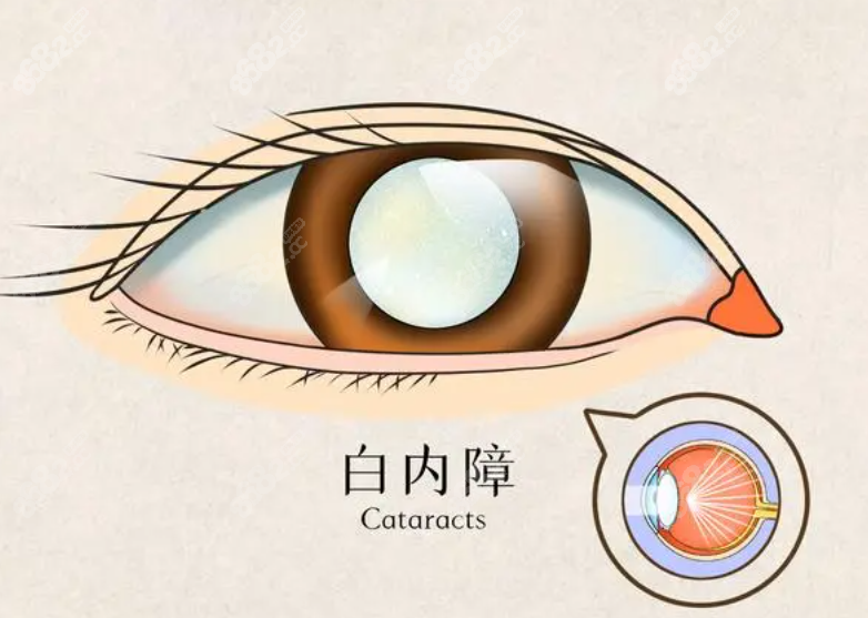 国内可以做的白内障手术眼科名单8682.cc