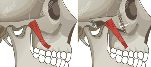 颧骨手术和下颌角手术的区别www.8682.cc