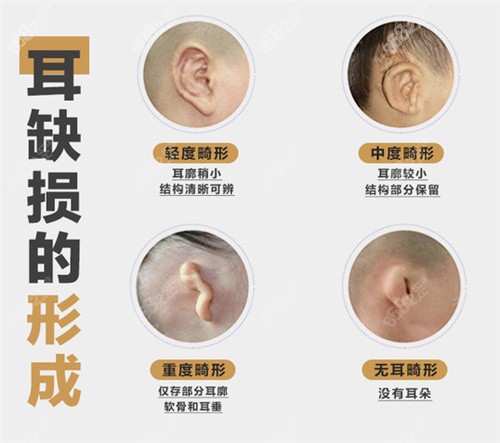 不同程度的耳畸形情况展示