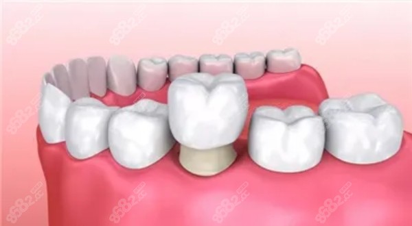 佛山种植牙1000左右是真的吗