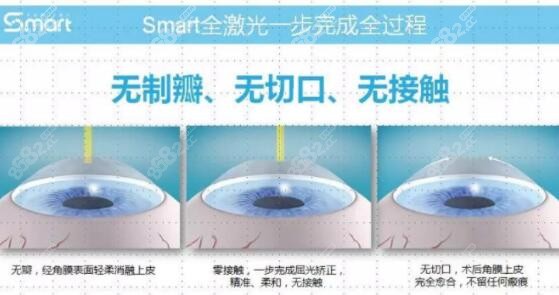 眼睛近视800度做SMART全激光准分子怎么样