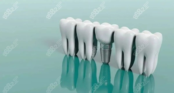 佛山有种植牙1000左右的吗8682.cc