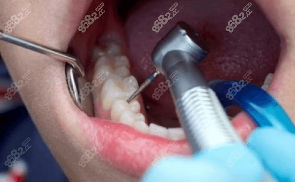 牙齿治疗 牙齿治疗