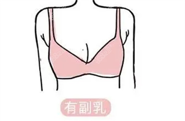 副乳