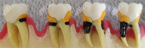 牙齿龋坏不断发展的照片